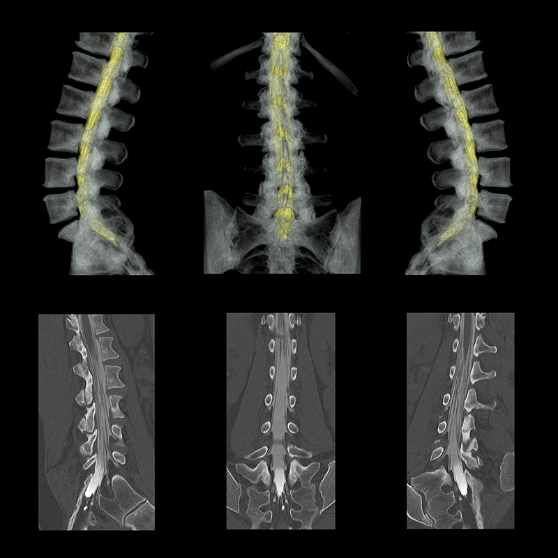 Aquilion Prime SP Lumbar Spine Myelogram