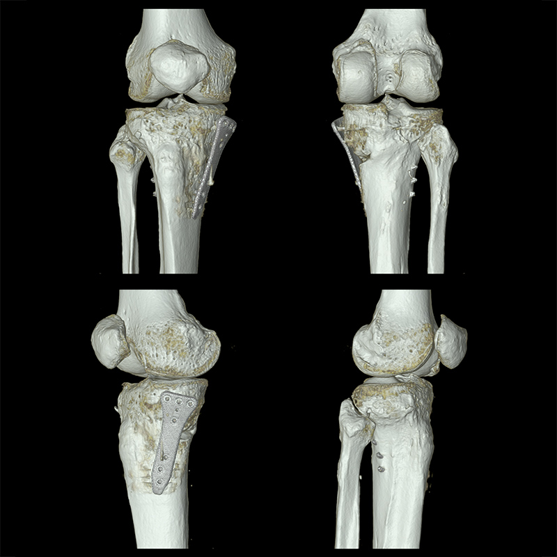 Aquilion Prime SP Knee Fixation - SEMAR