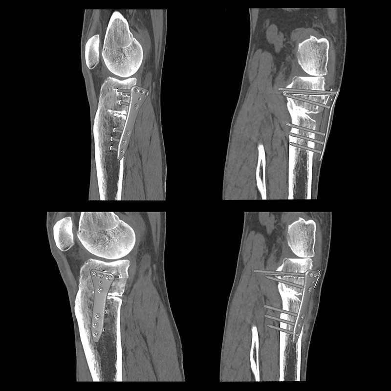 Aquilion Prime SP Knee Fixation - SEMAR