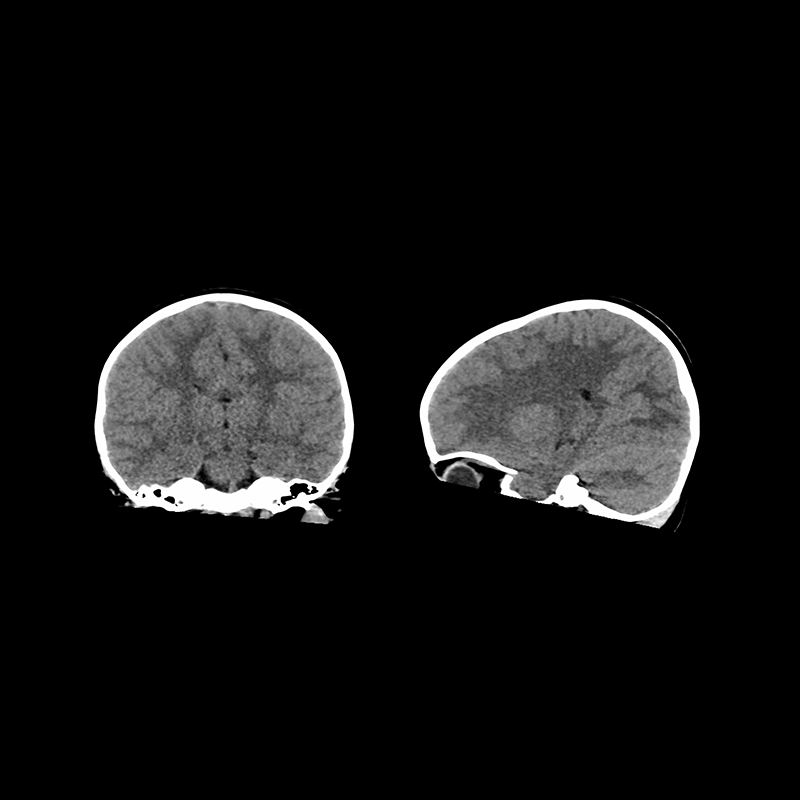 Aquilion Prime SP Brain 2-year-old, AiCE LCD