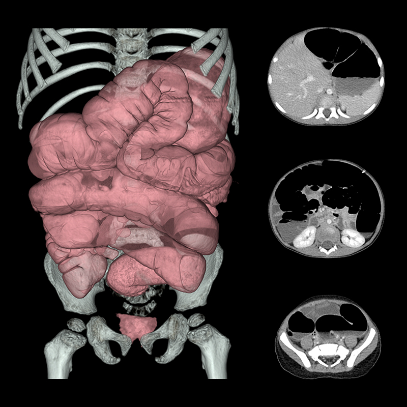Aquilion Prime SP Colonic Distention