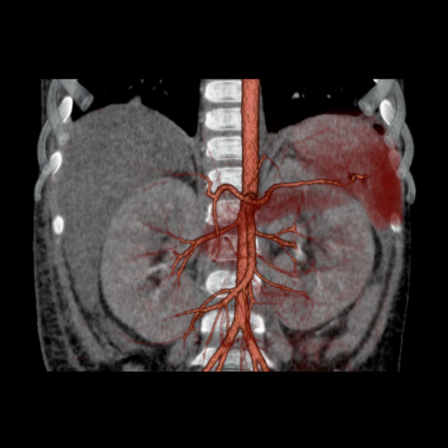 Aquilion Prime SP Renal CT Angiography