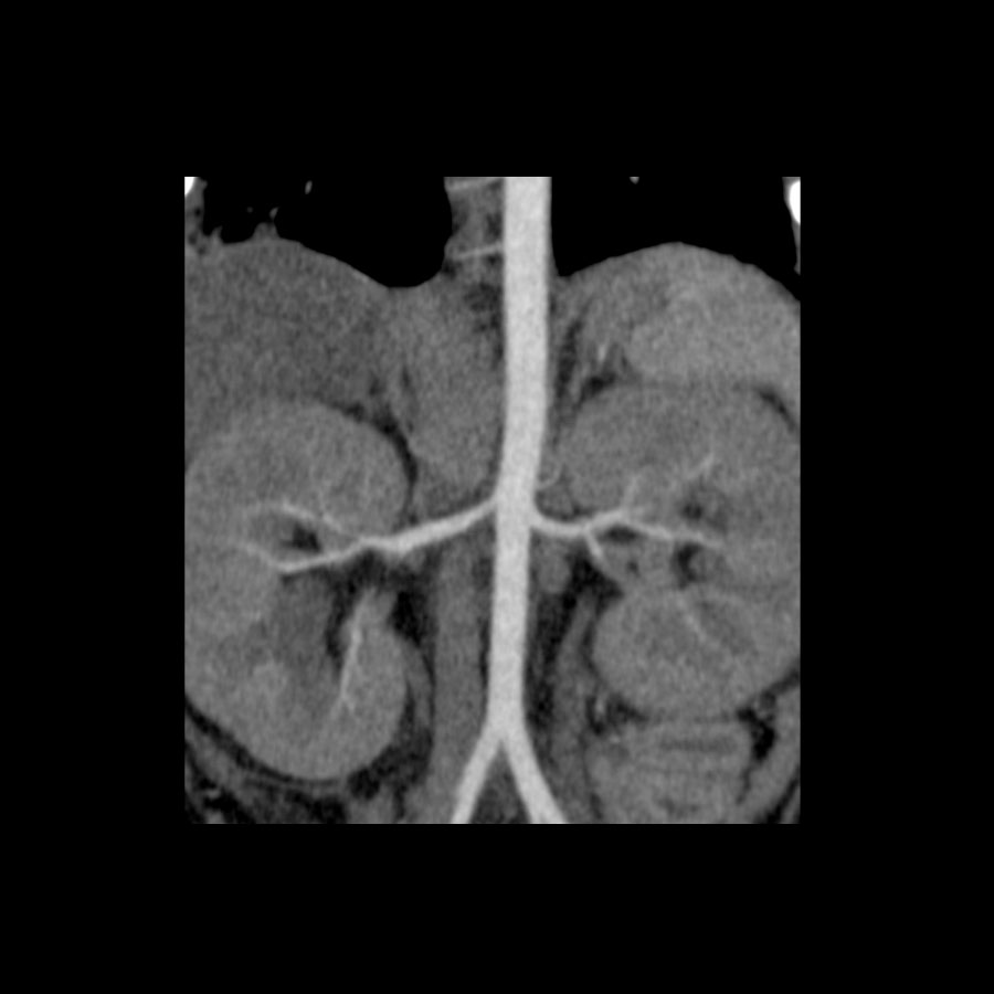 Aquilion Prime SP Renal CT Angiography