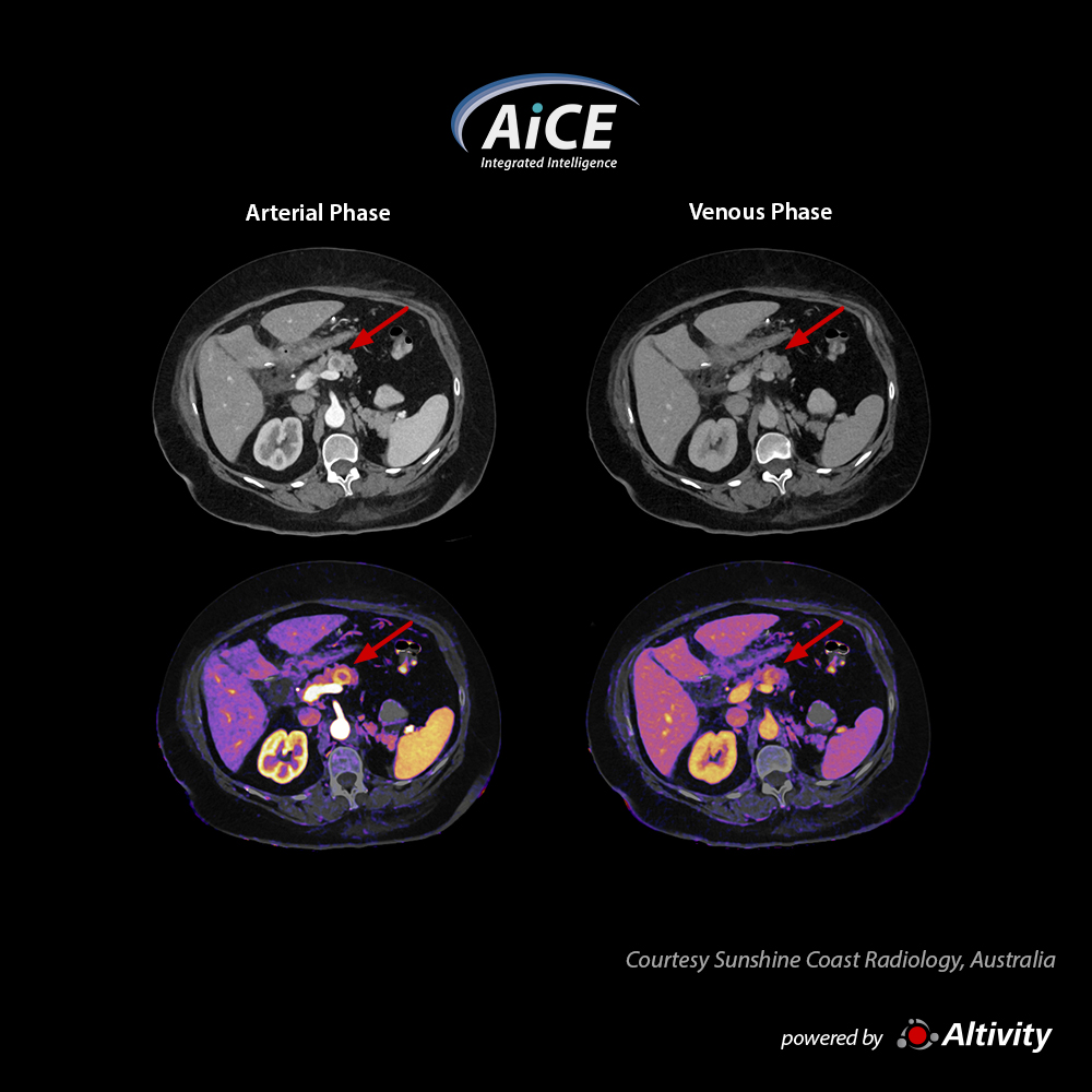 Aquilion Serve SP Abdomen with iodine maps