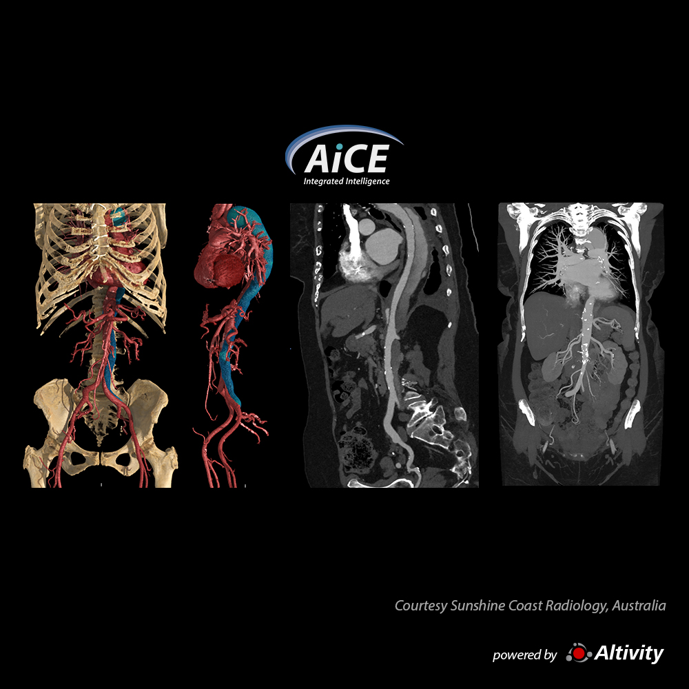 Aquilion Serve SP Aorta CTA - Dissection
