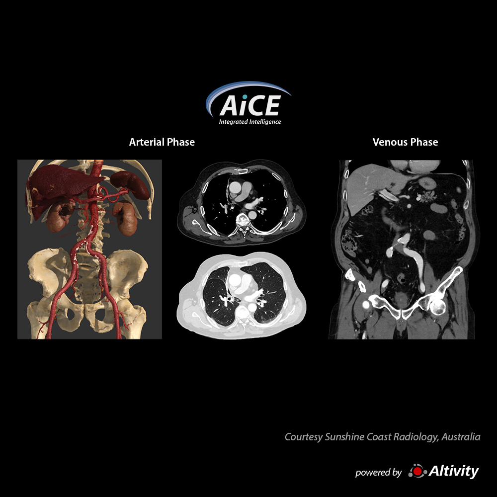 Aquilion Serve SP Chest/Abdomen/Pelvis