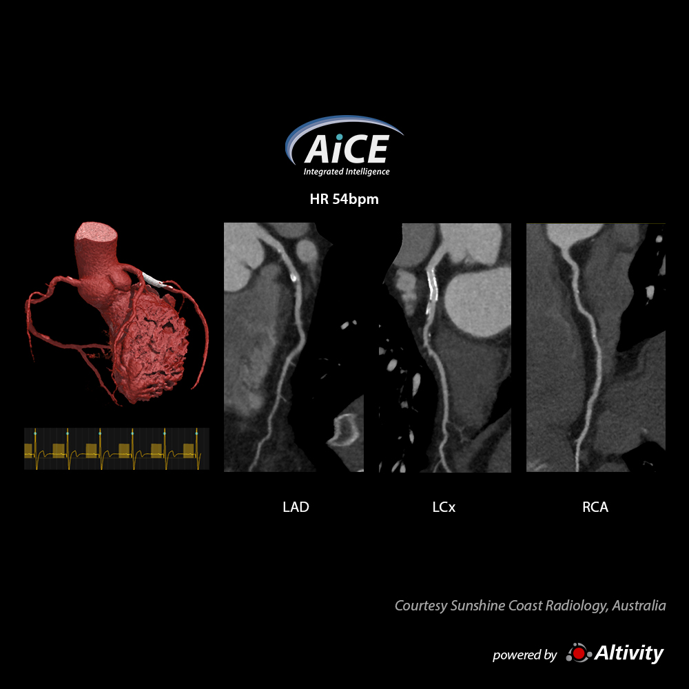 Aquilion Serve SP Cardiac - Stent