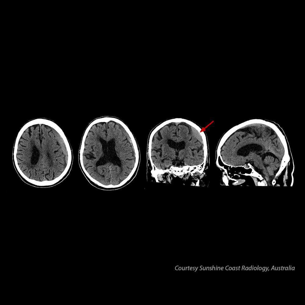 Aquilion Serve SP Brain – Subdural Hematoma