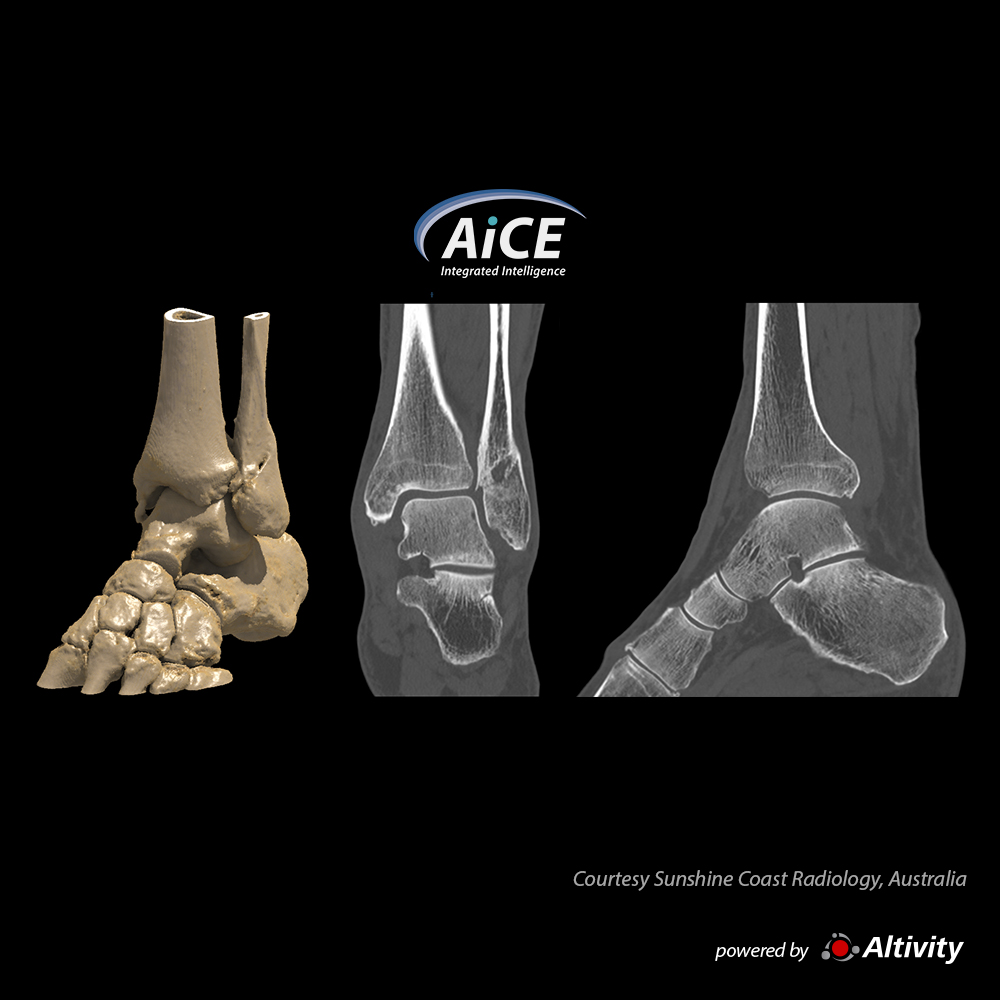 Aquilion Serve SP Ankle - Fracture