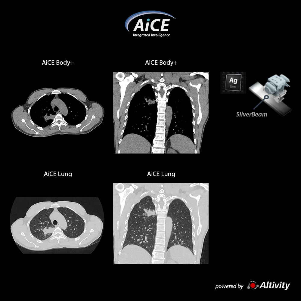 Aquilion Serve Low dose chest with SilverBeam