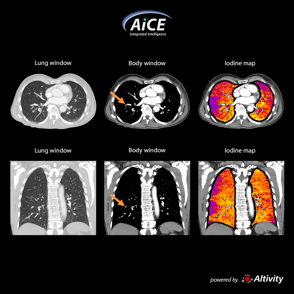 Aquilion Serve Pulmonary CTA - Iodine Mapping SCT
