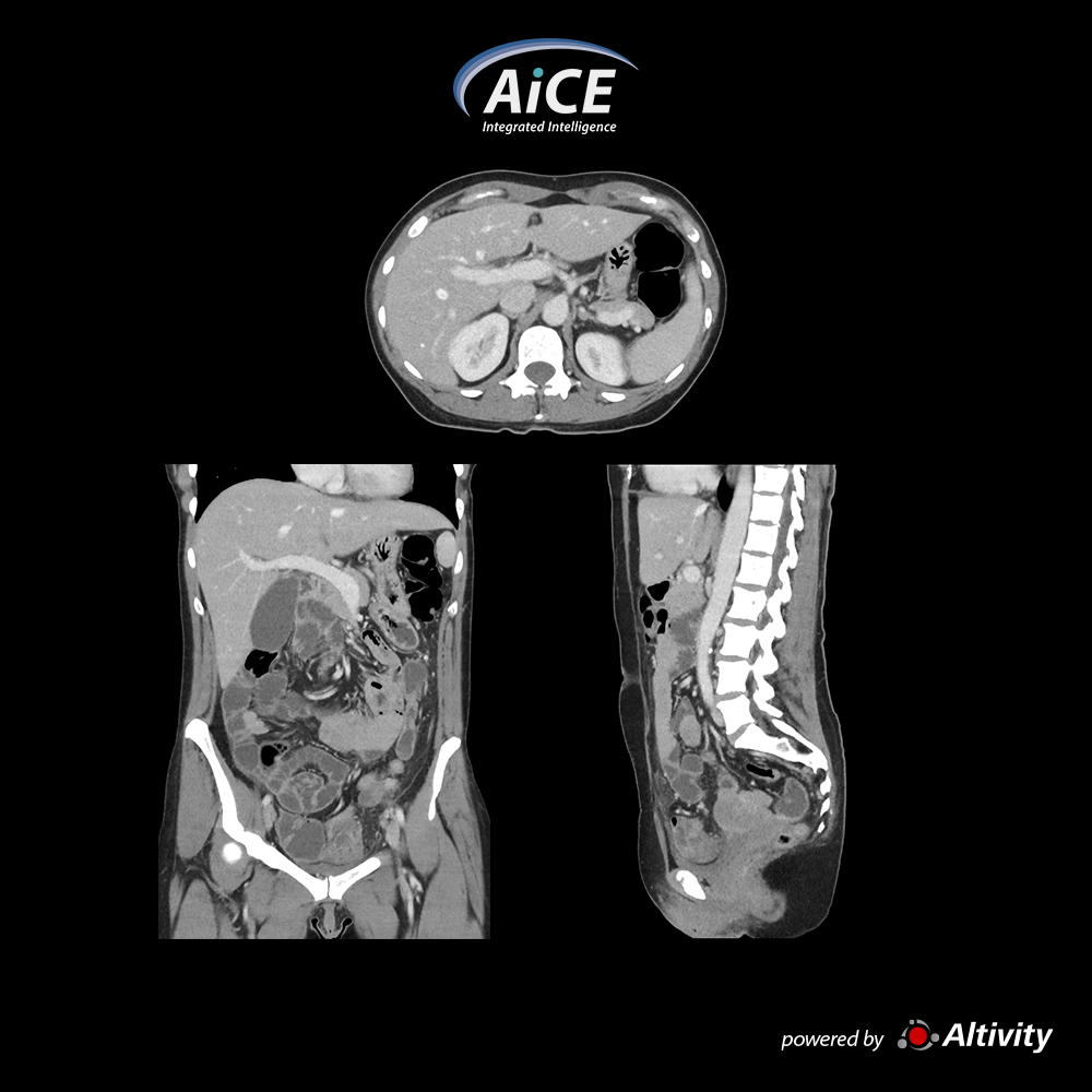 Aquilion Serve Portal Abdomen
