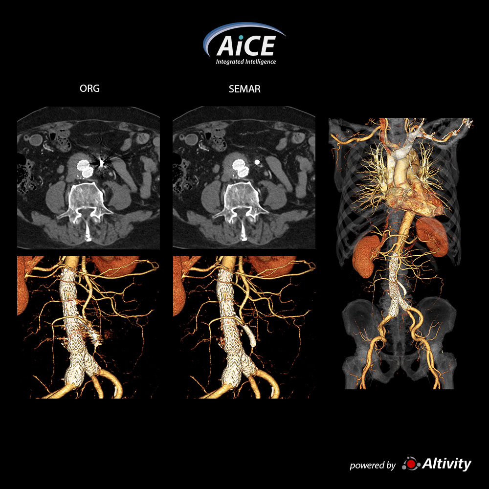 Aquilion Serve Aorta CTA + SEMAR