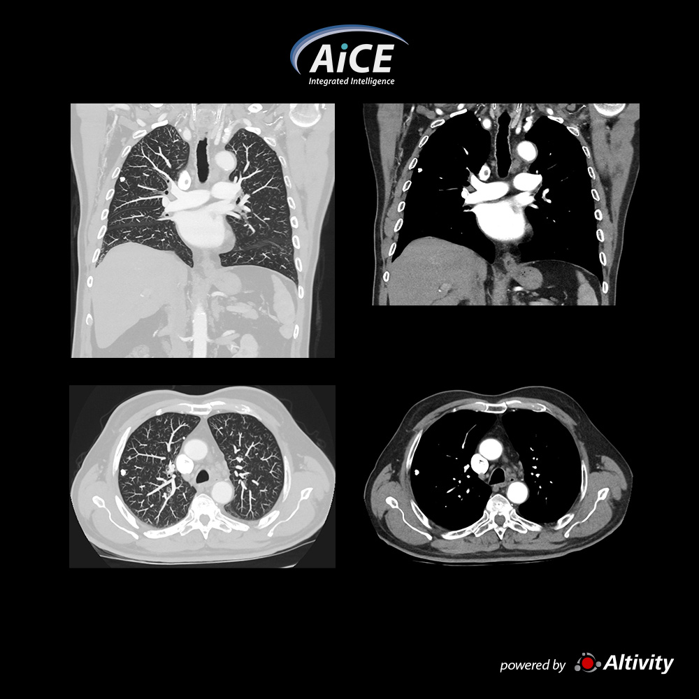 Aquilion Serve Chest – Calcified Nodule
