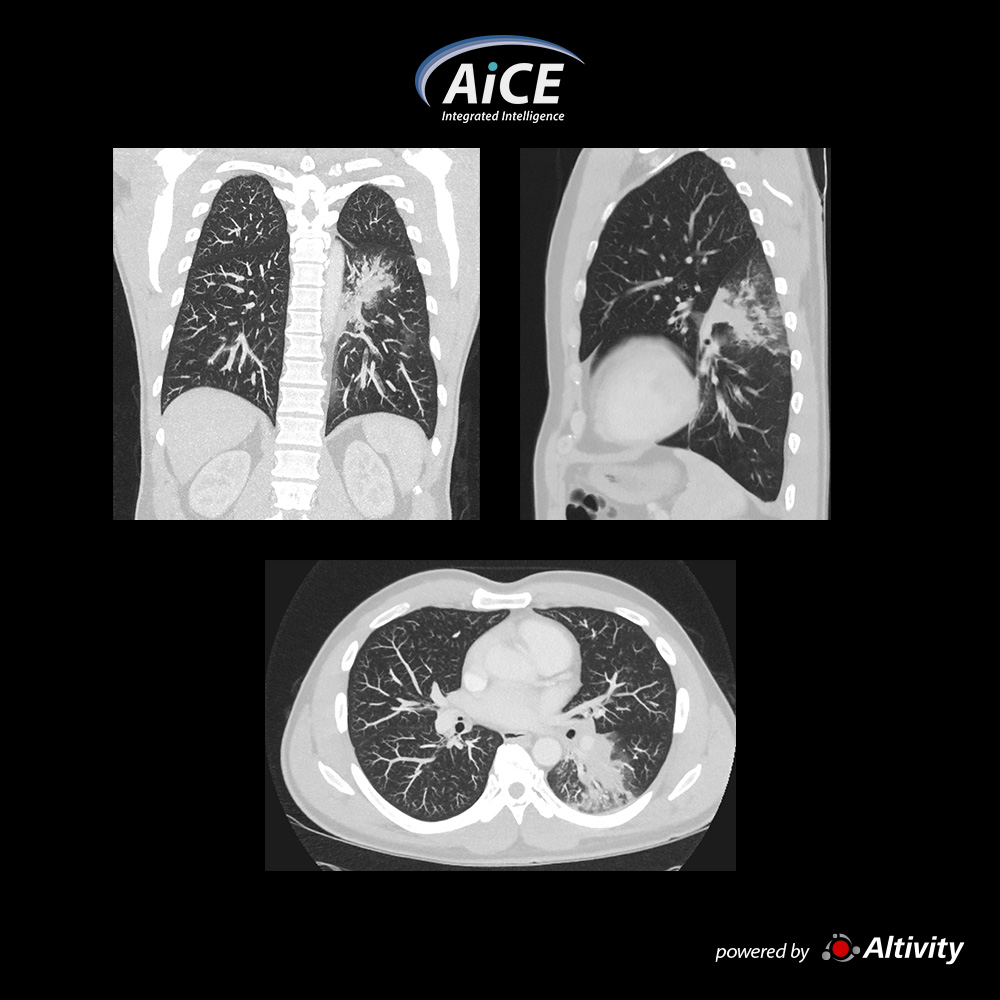 Aquilion Serve Chest - Pneumonia