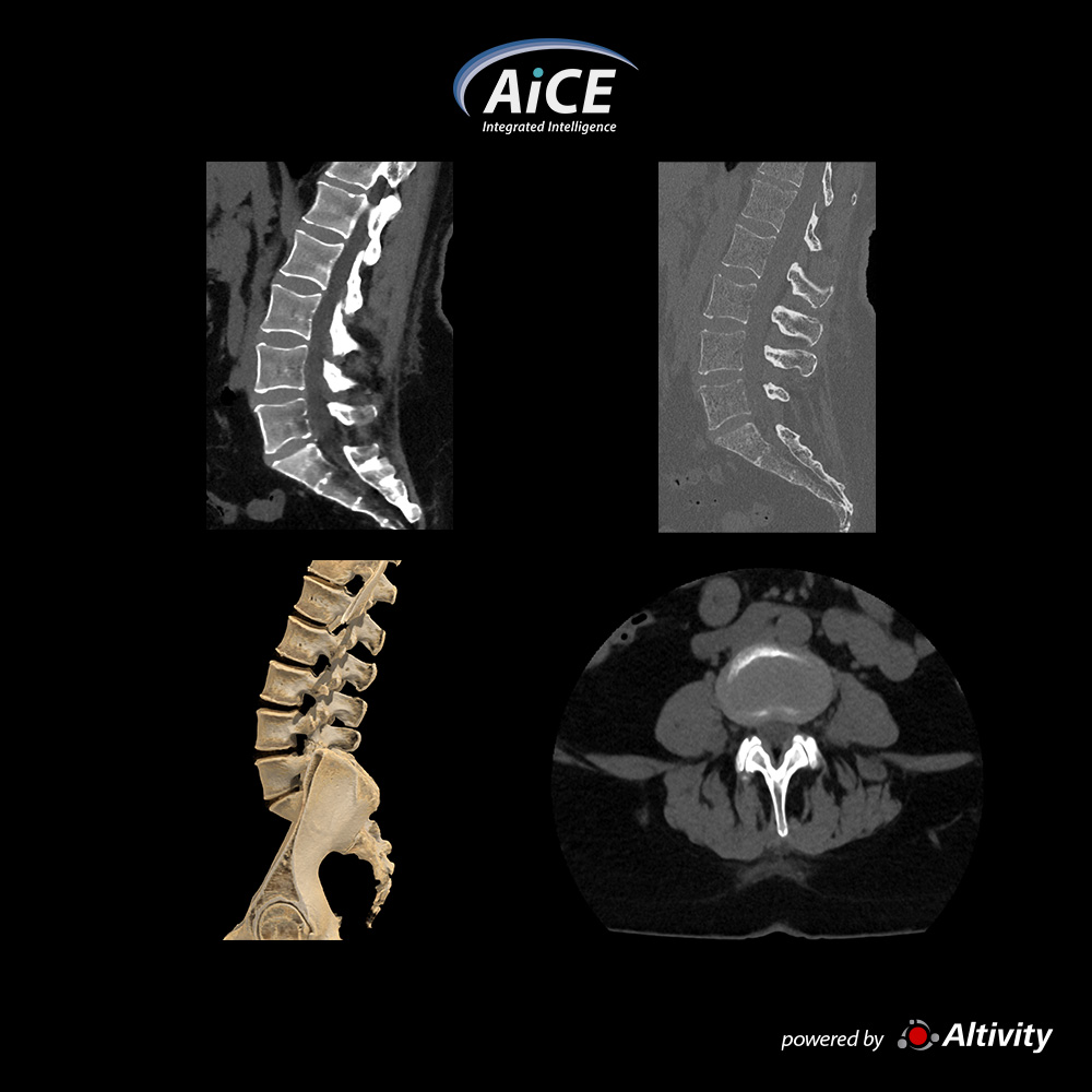 Aquilion Serve Lumbar Spine
