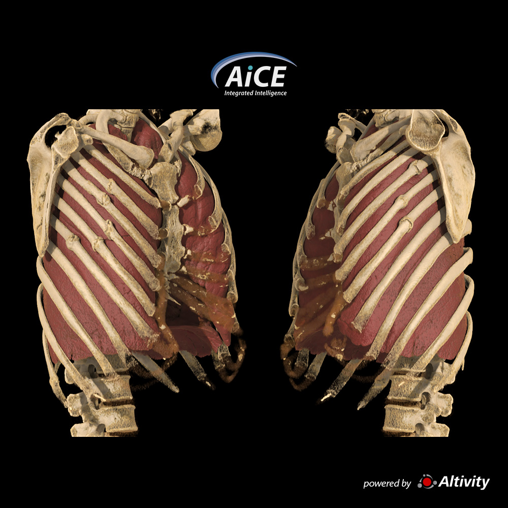 Aquilion Serve Rib Fractures