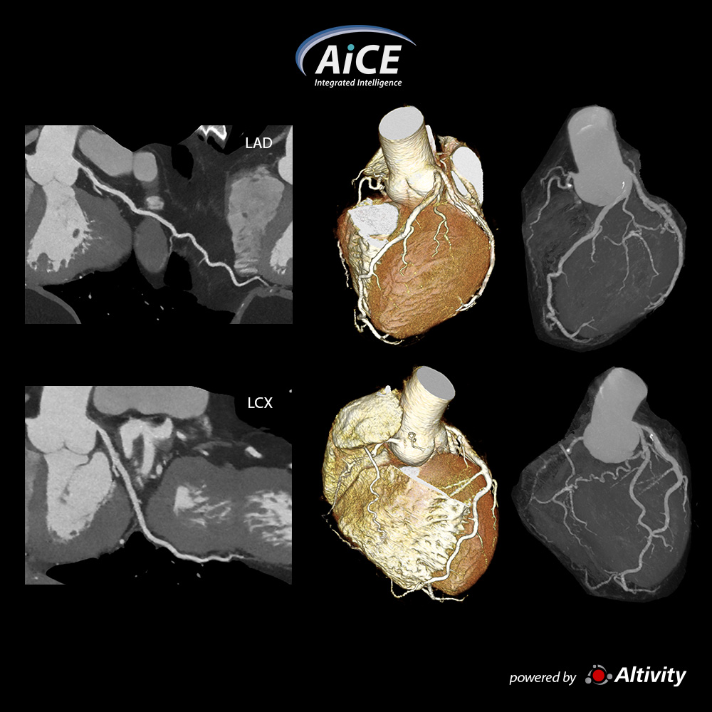 Aquilion Serve Cardiac