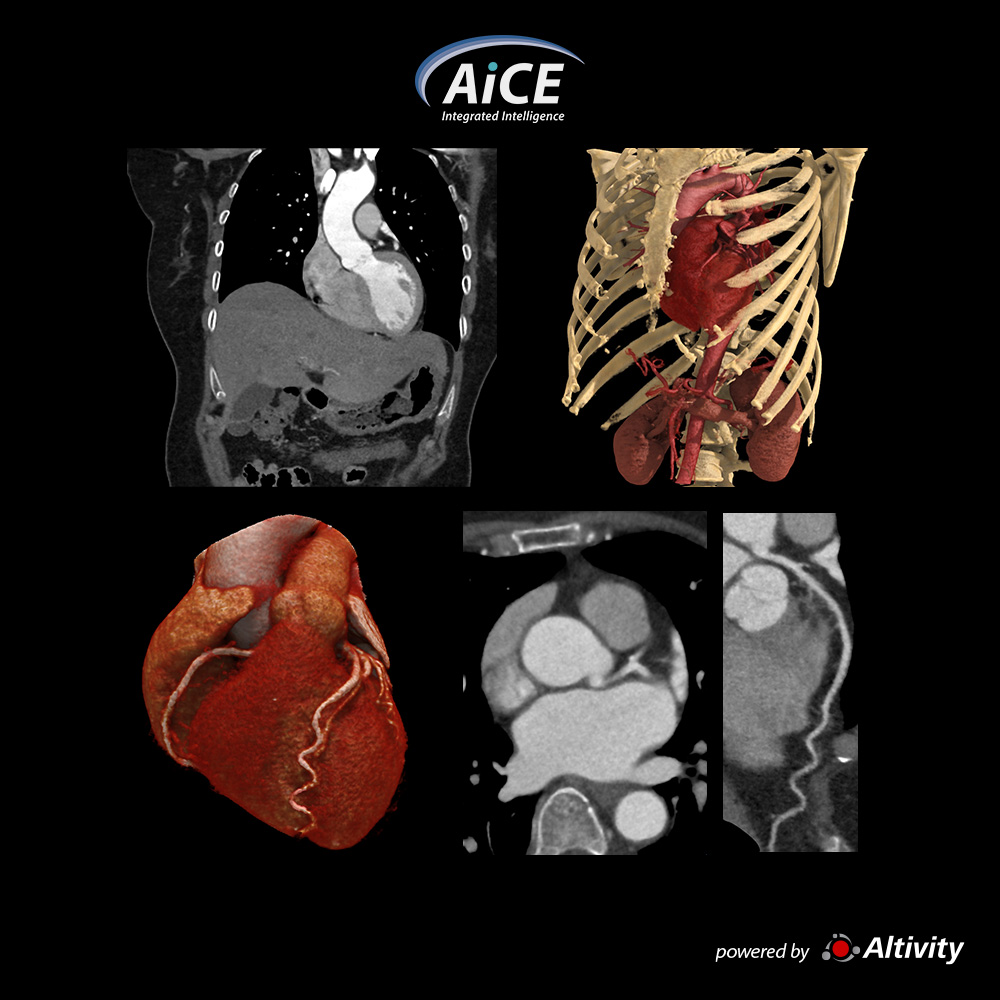 Aquilion Serve Thoracic Aorta – vHP