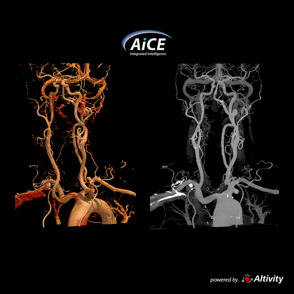 Aquilion Serve Carotid Angio SCT