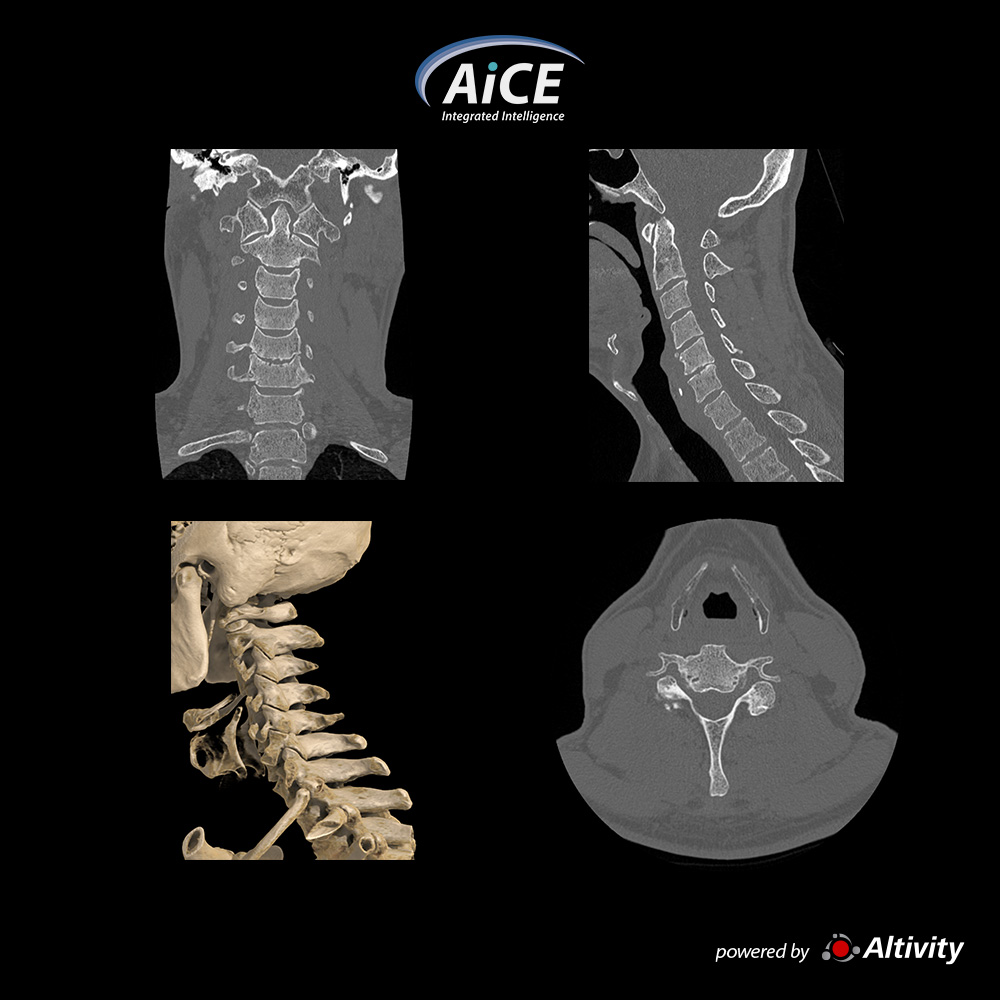Aquilion Serve Cervical Spine