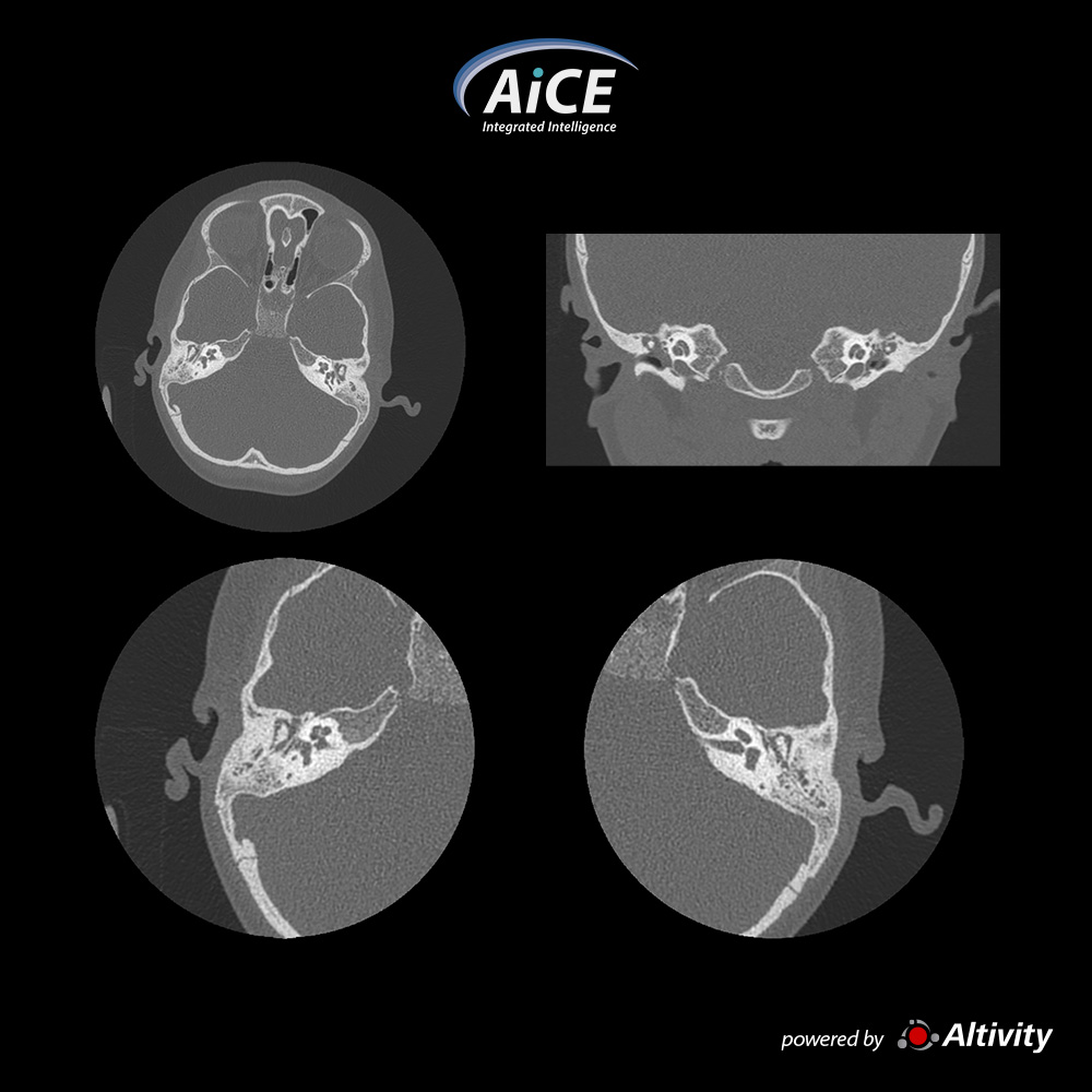 Aquilion Serve Inner Ear – 4-year-old child