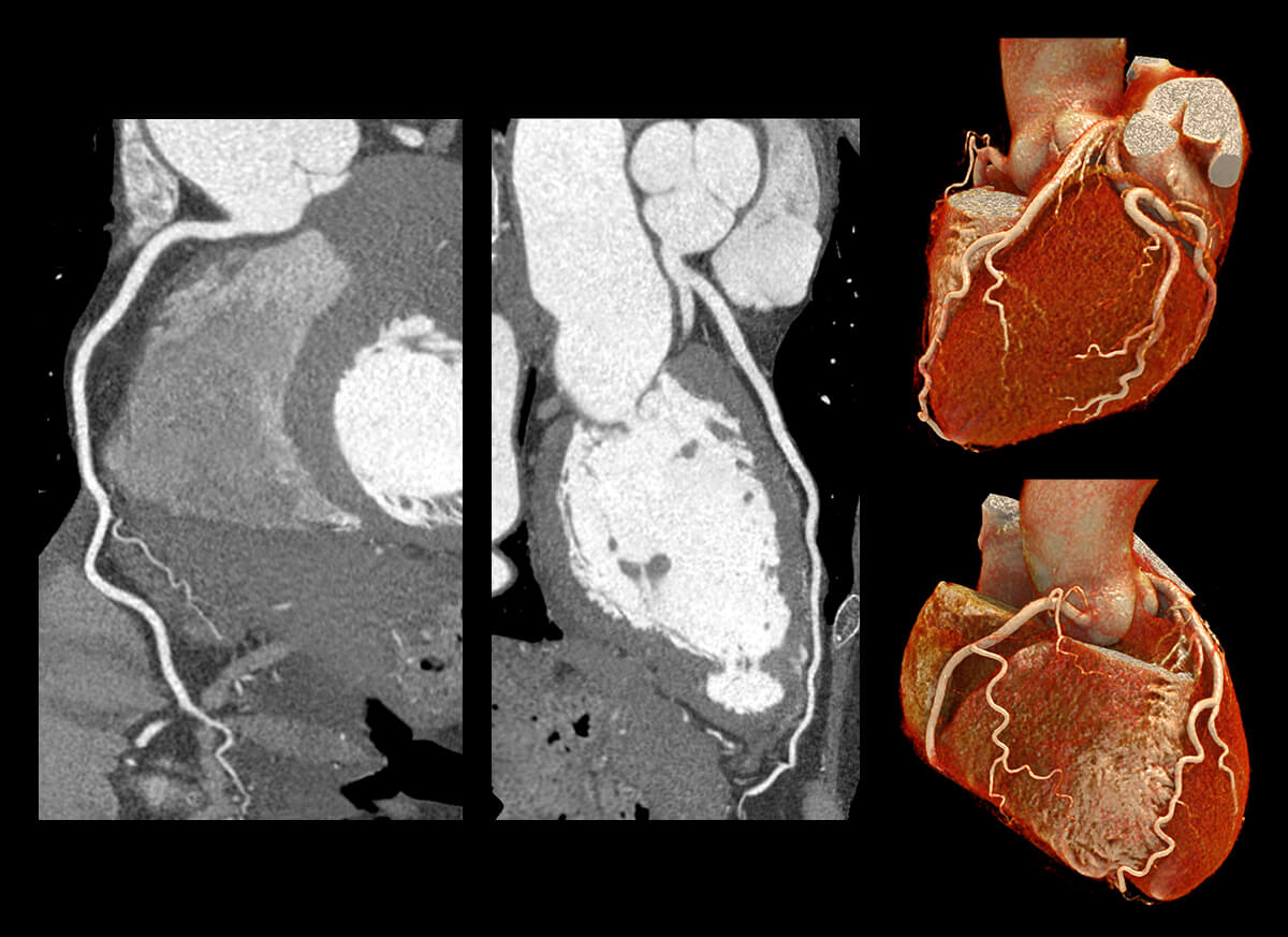 Coronary