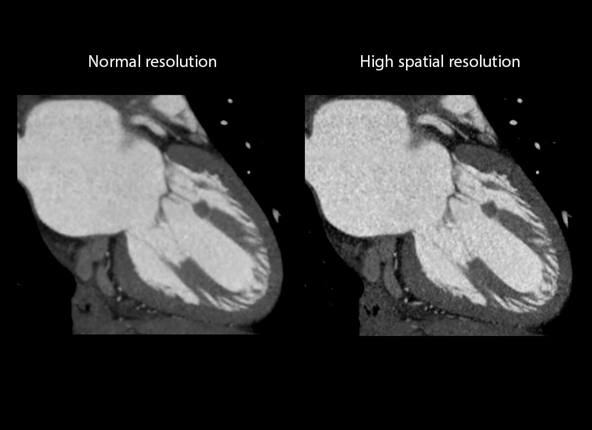 Photon Counting CT Papillary muscle and chordae tendinea