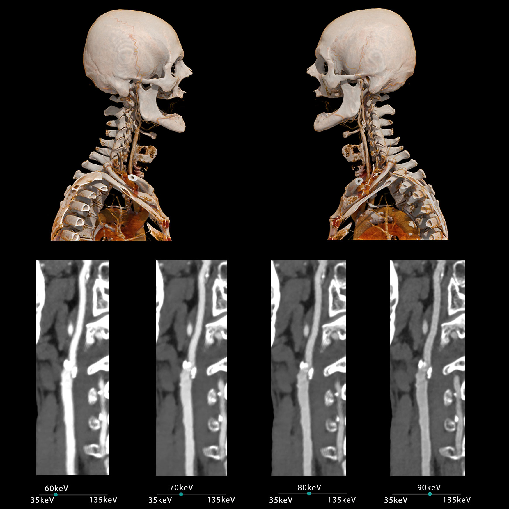 Aquilion ONE / PRISM Edition Carotid CTA – Monochromatic Analysis