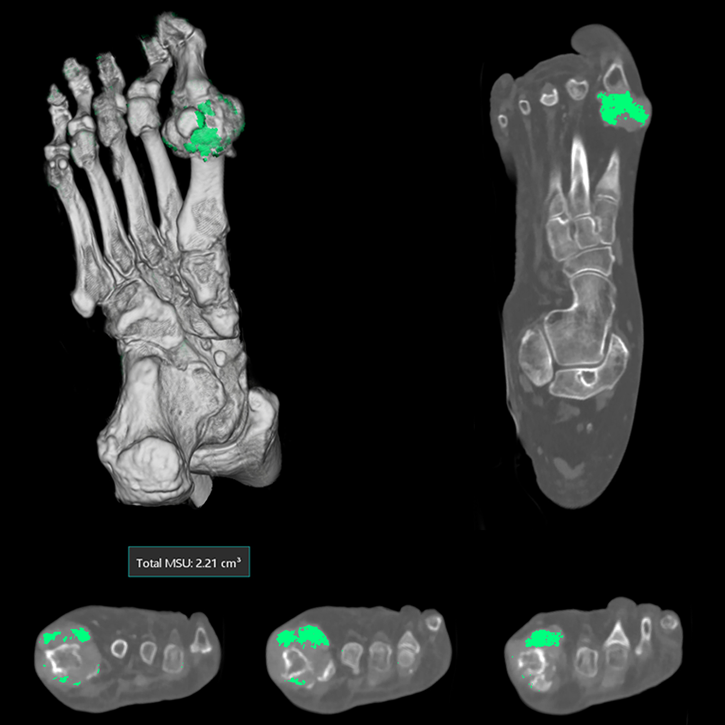 Gout Analysis
