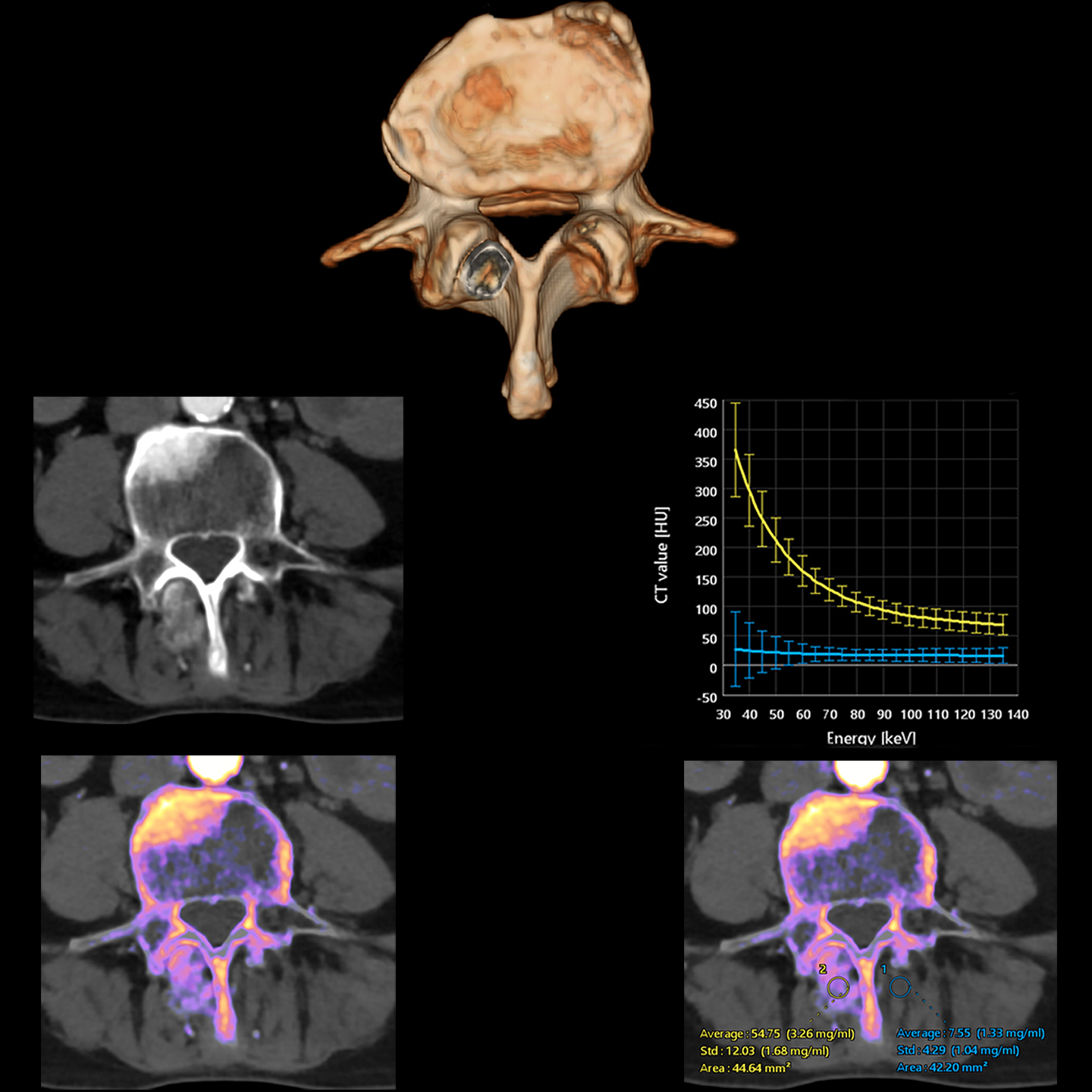 Aquilion ONE / PRISM Edition Spine Metastasis — Iodine Map Analysis