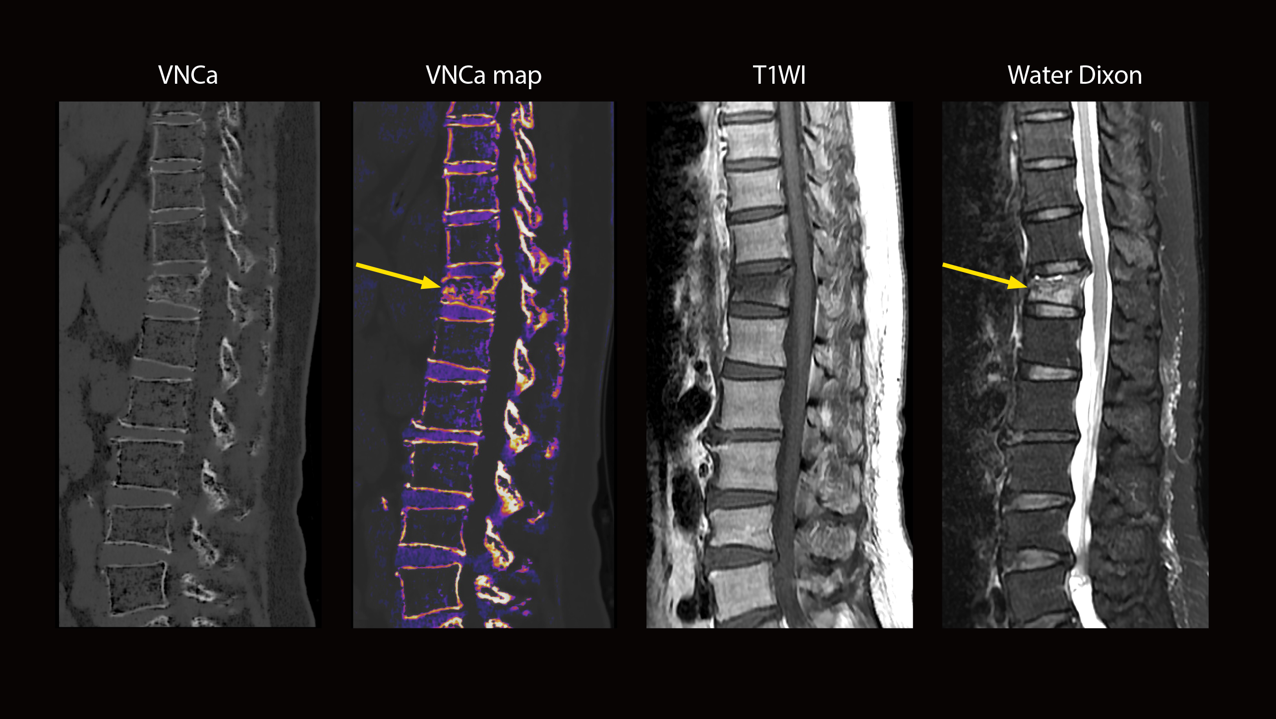 Aquilion ONE / PRISM Edition Acute compression fracture with bone marrow mapping