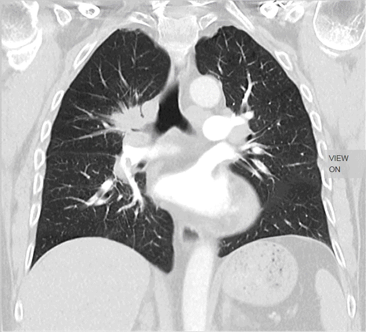 SURE Subtraction Lung2