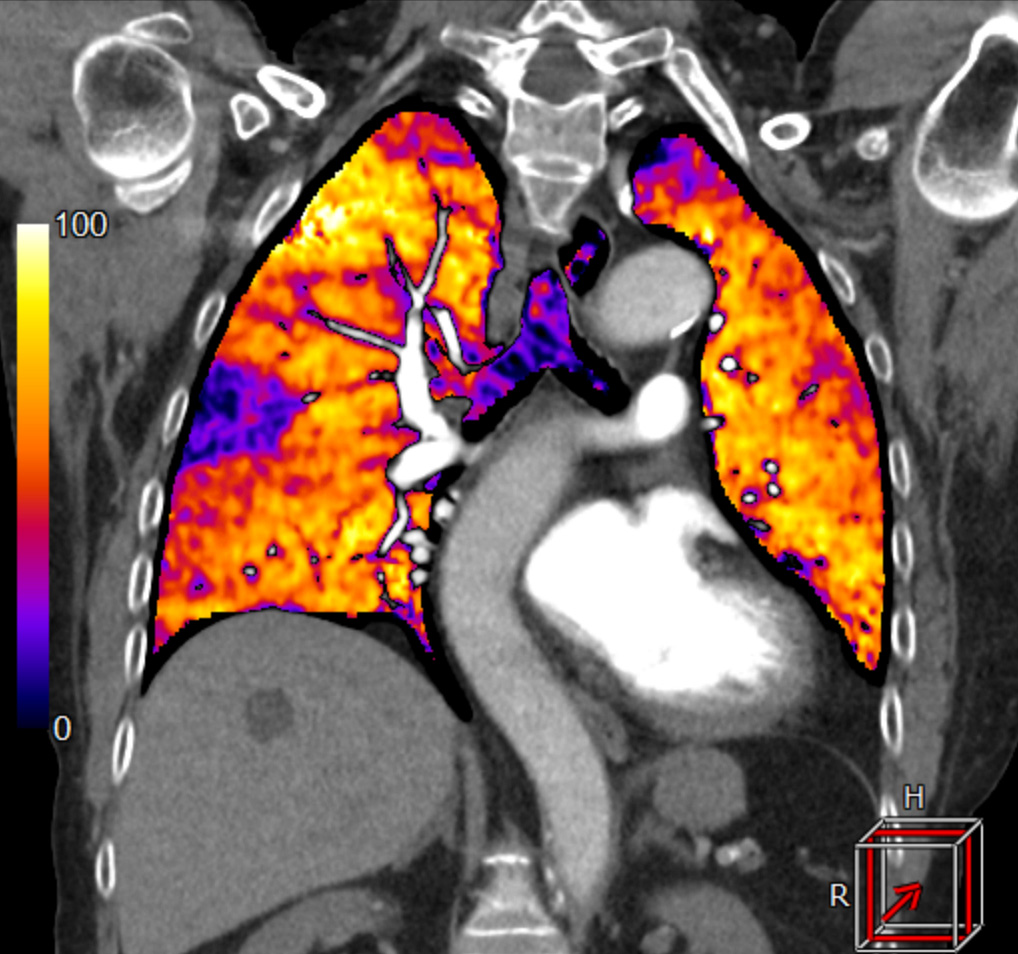 SURE Subtraction Lung1