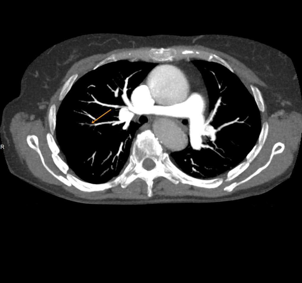 SURE Subtraction Lung1