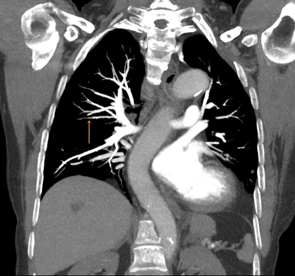 SURE Subtraction Lung1