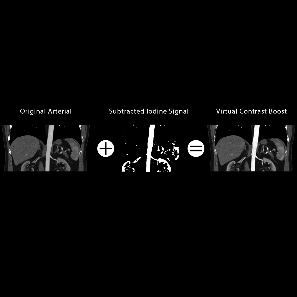 SURE Subtraction Virtual Contrast Boost
