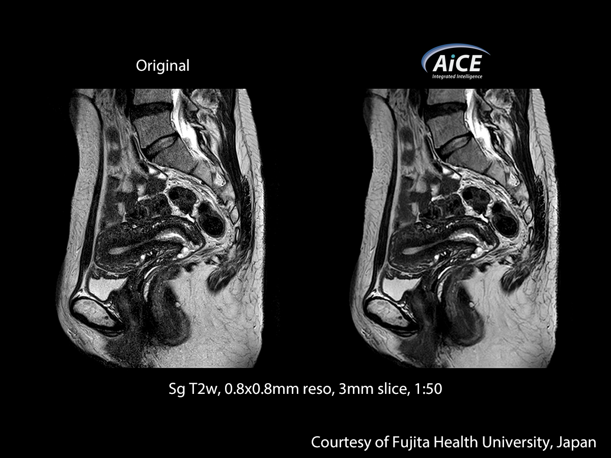 Advanced intelligent Clear-IQ Engine Abdomen