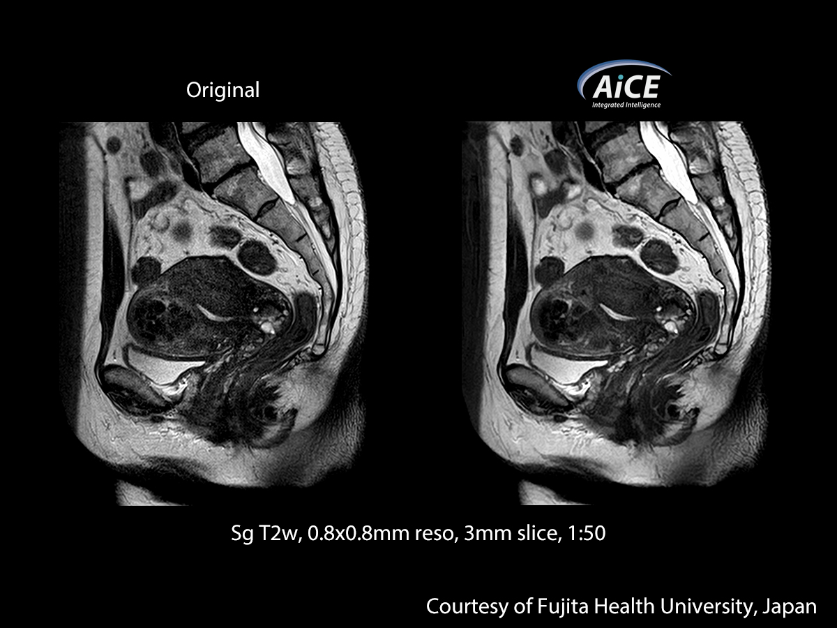 Advanced intelligent Clear-IQ Engine Abdomen