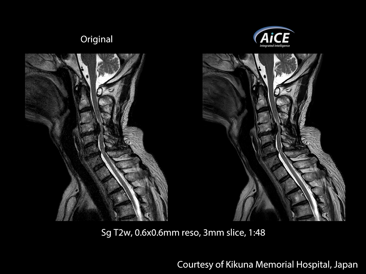 Advanced intelligent Clear-IQ Engine Spine