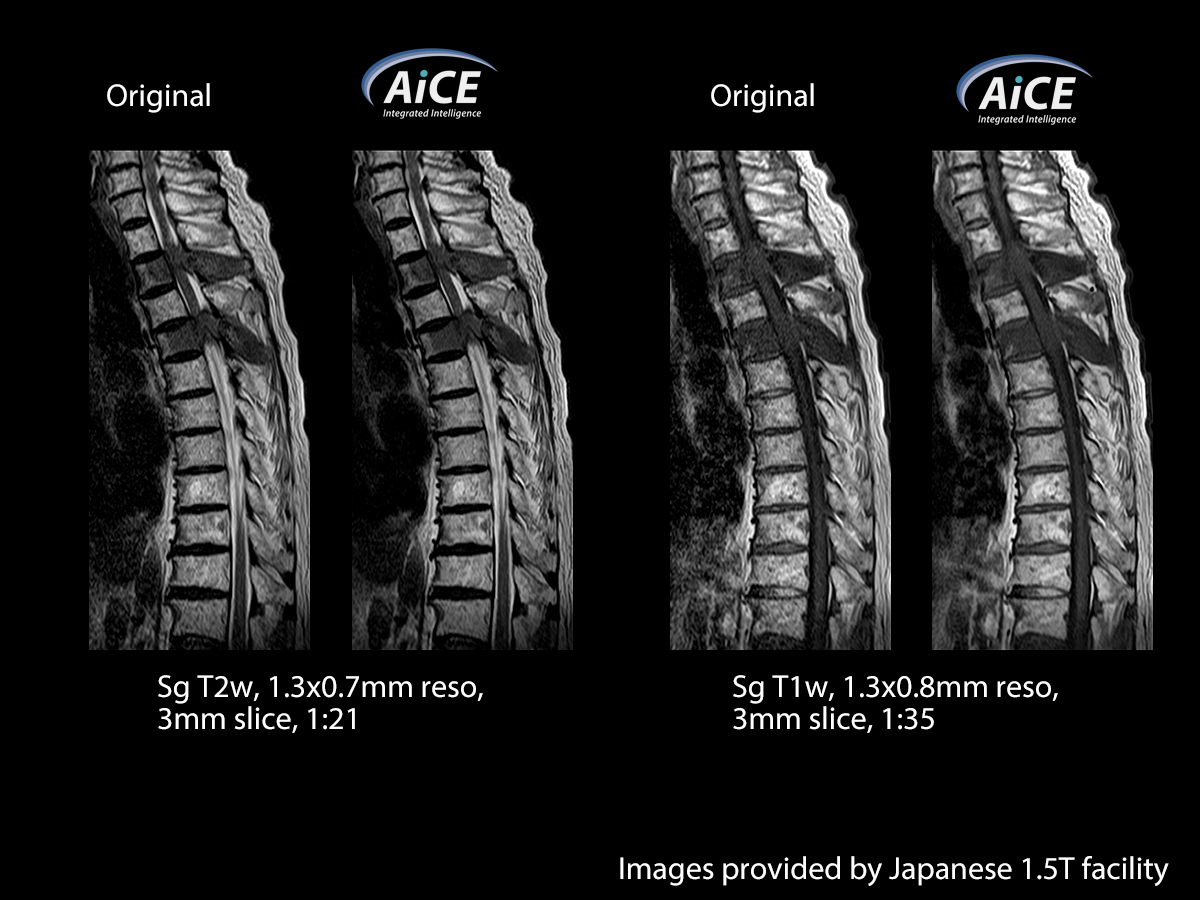 Advanced intelligent Clear-IQ Engine Spine