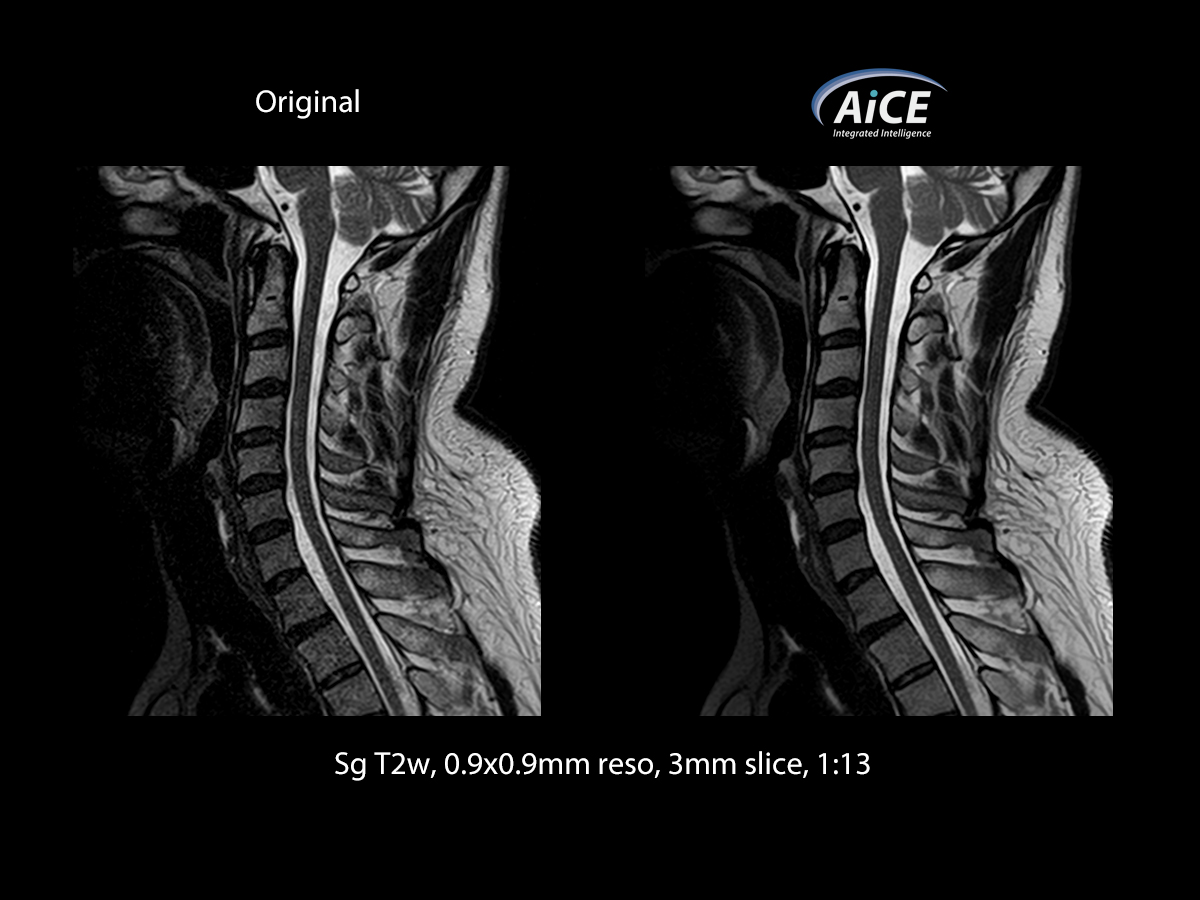 Advanced intelligent Clear-IQ Engine Spine