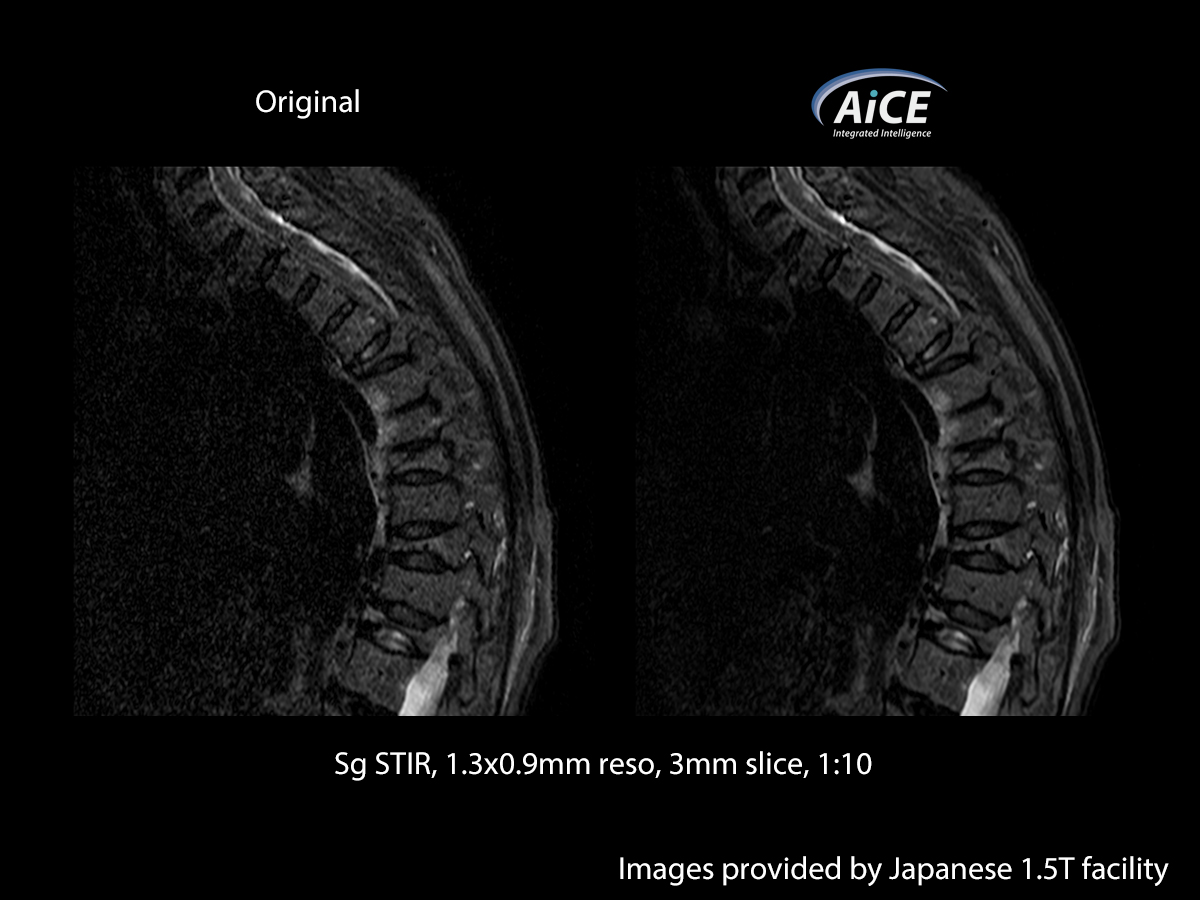 Advanced intelligent Clear-IQ Engine Spine
