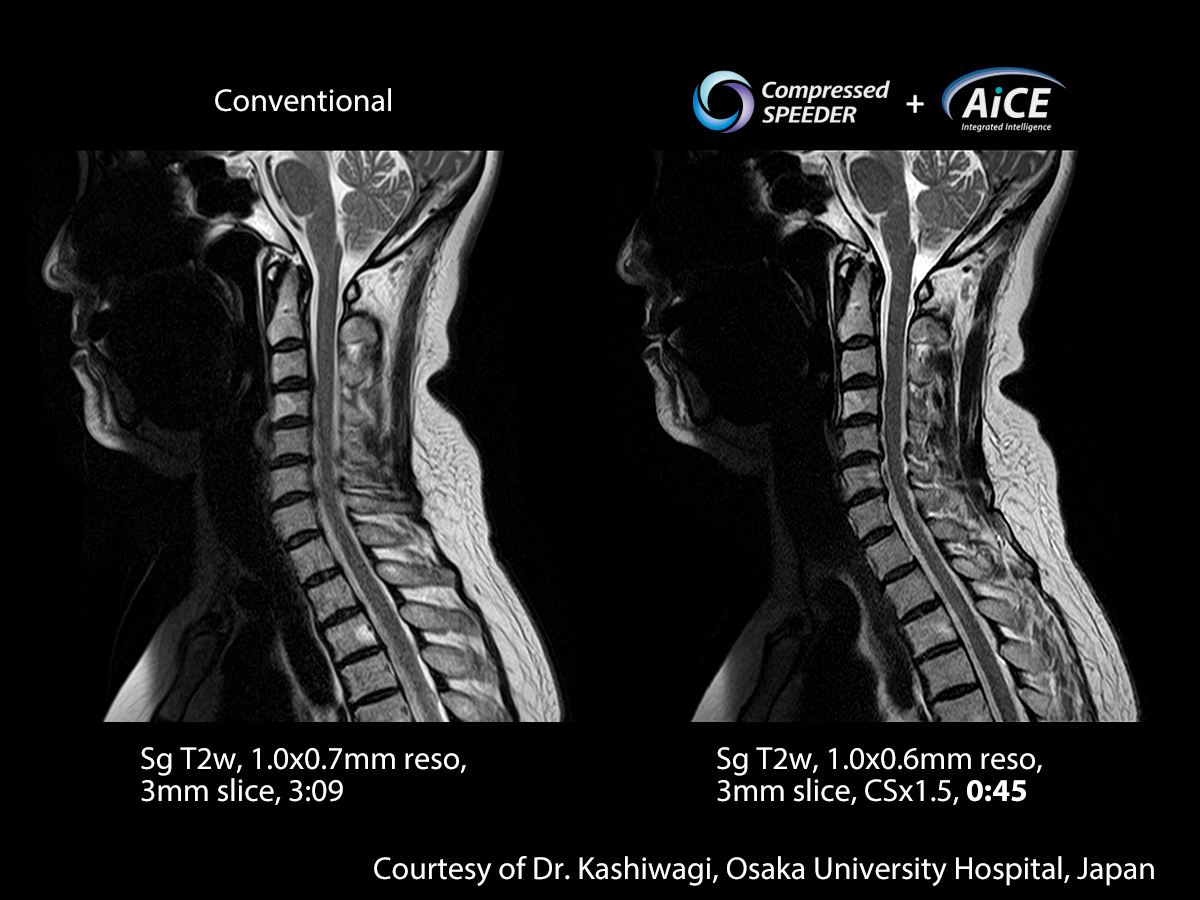 Advanced intelligent Clear-IQ Engine Spine