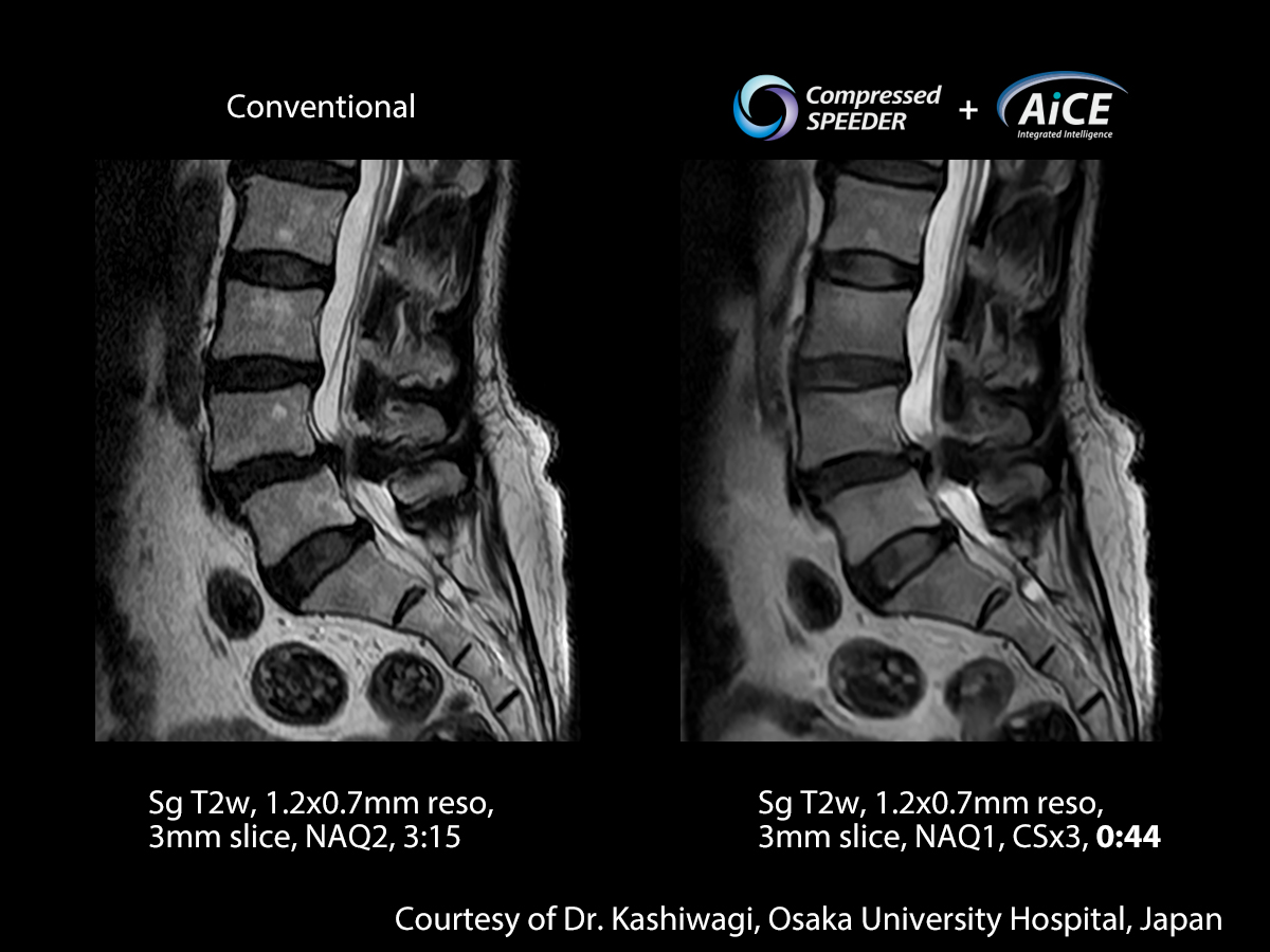 Advanced intelligent Clear-IQ Engine Spine