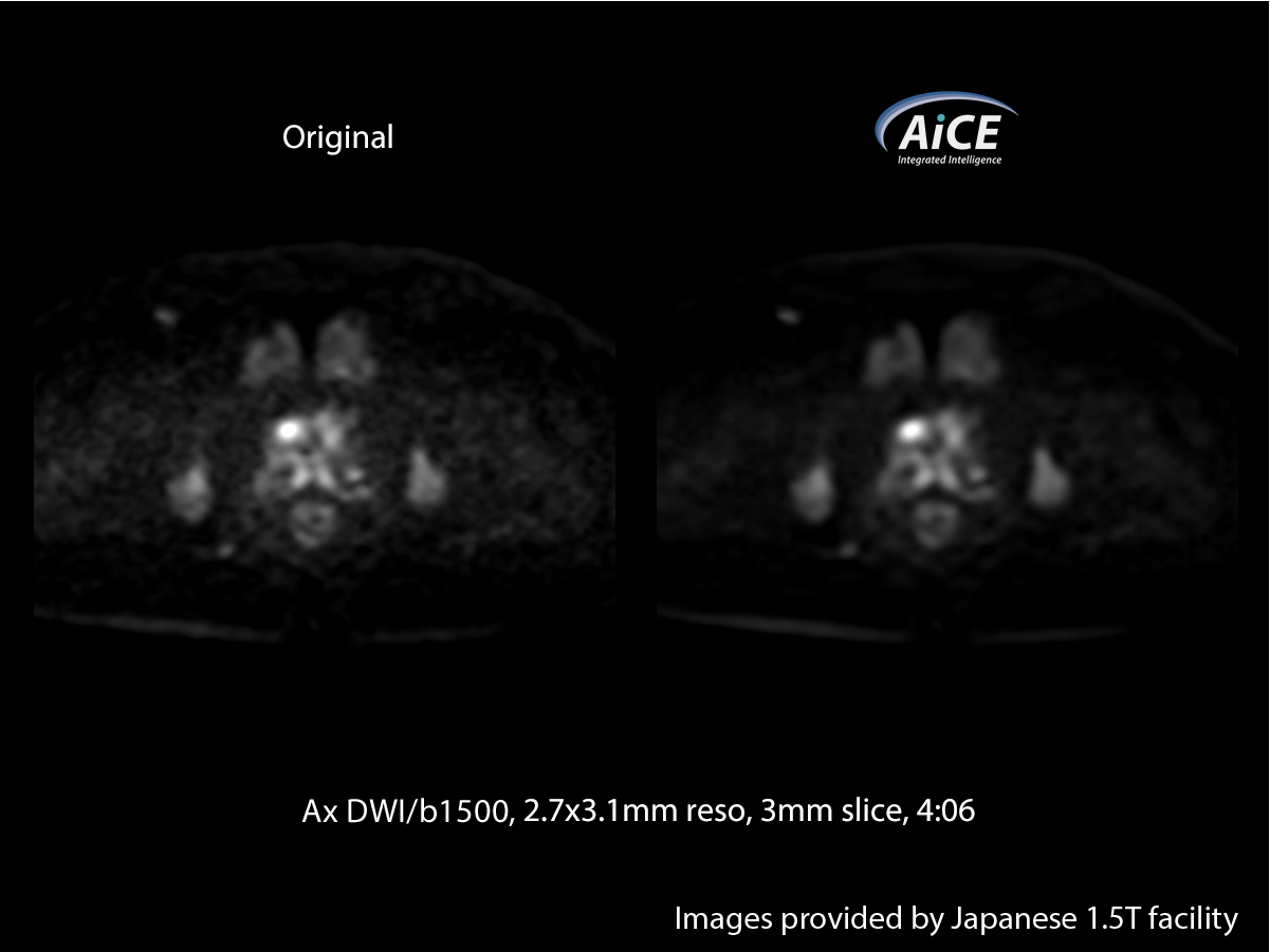 Advanced intelligent Clear-IQ Engine Abdomen