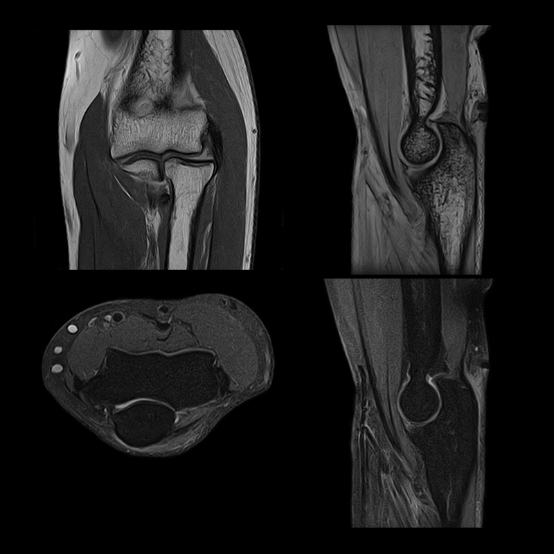 Vantage Elan Orthopedic Upper