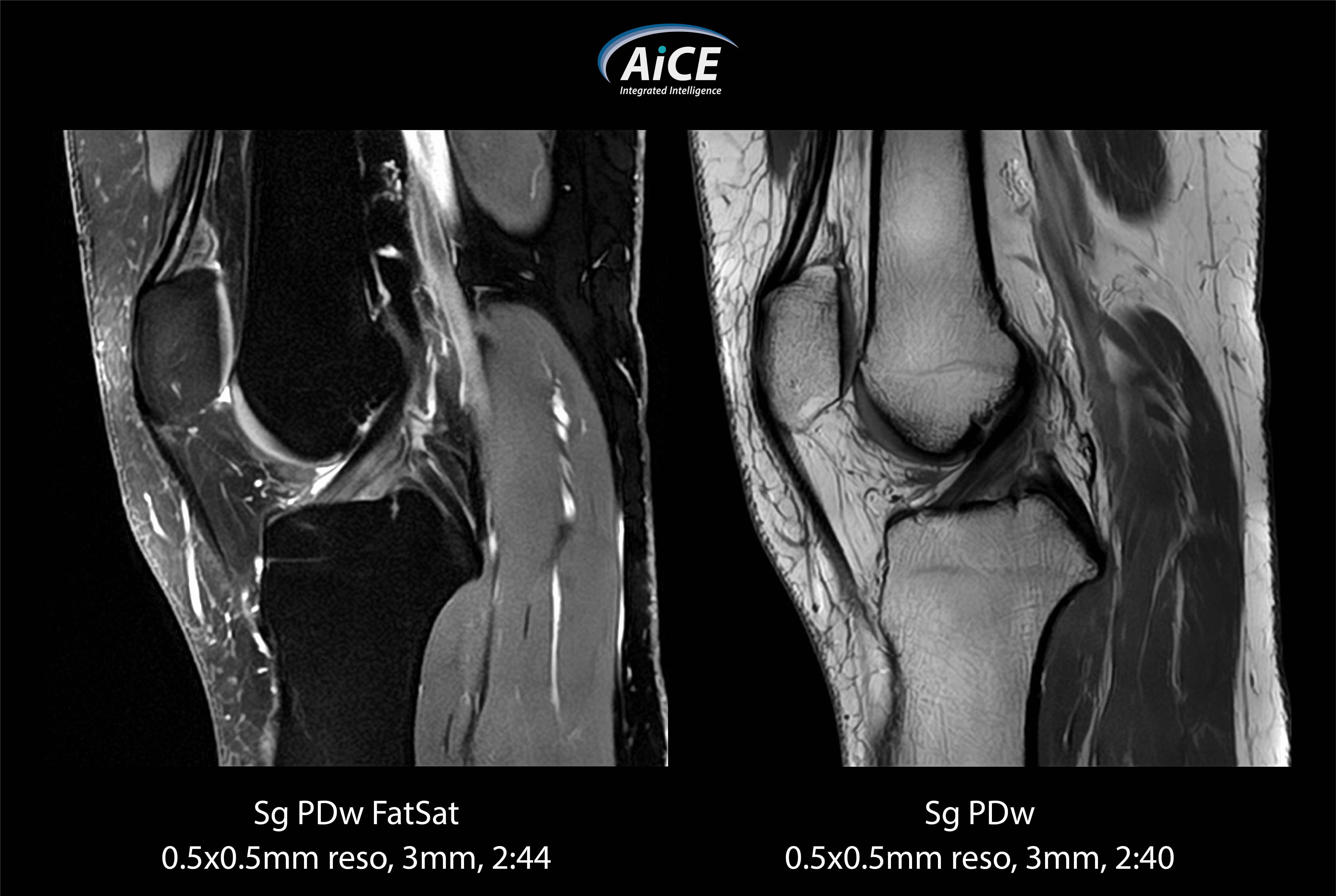 Vantage Elan Knee
