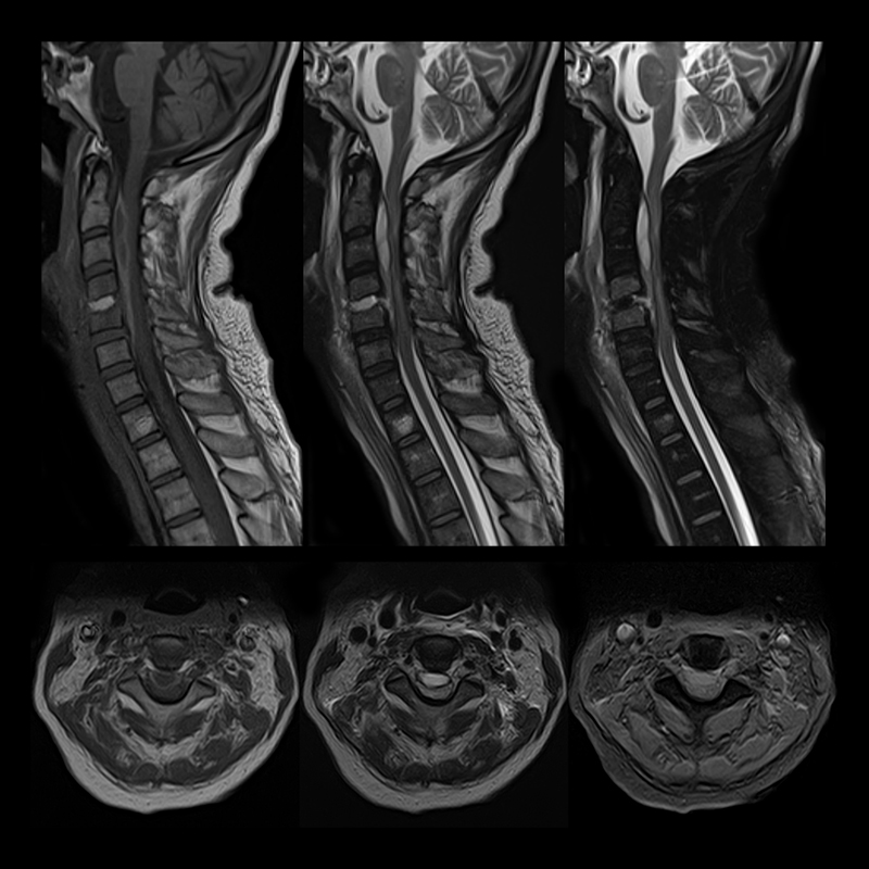 Vantage Elan Spine