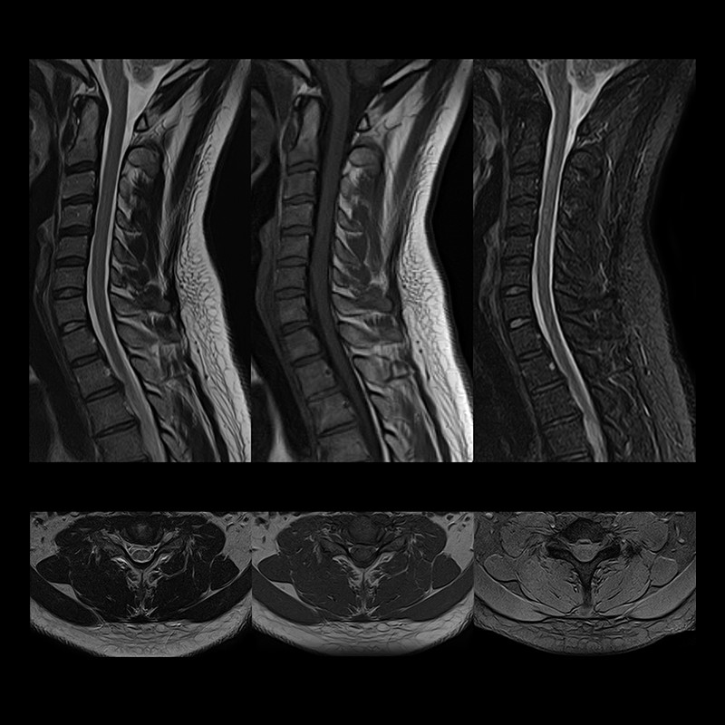 Vantage Elan Spine